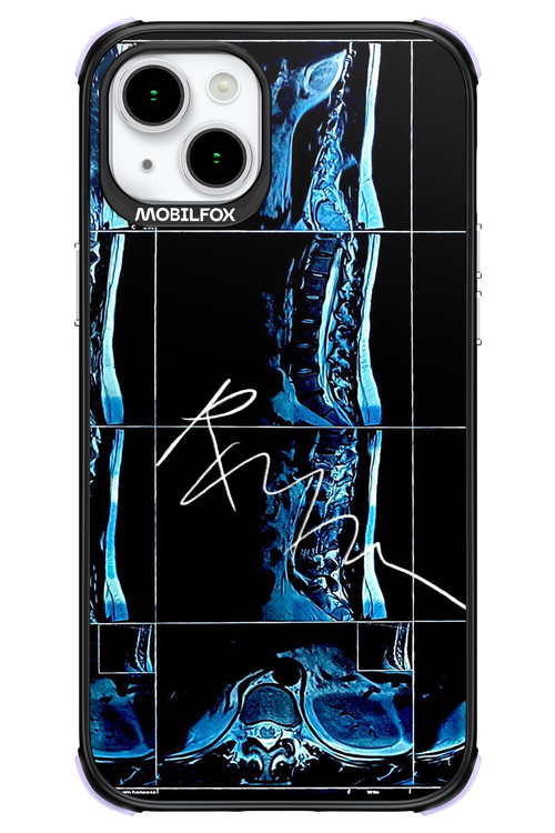 RMN Scolioza 2.0 - Apple iPhone 15 Plus