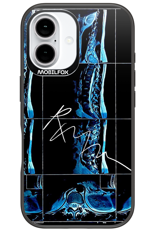RMN Scolioza 2.0 - Apple iPhone 16