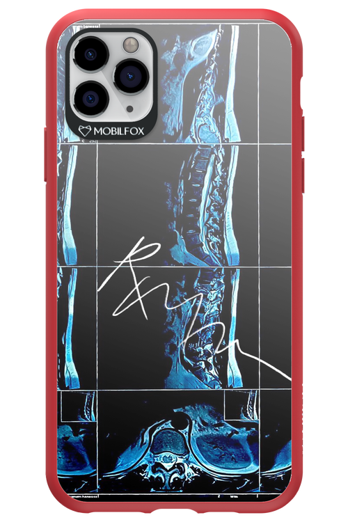 RMN Scolioza 2.0 - Apple iPhone 11 Pro Max