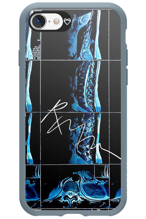 RMN Scolioza 2.0 - Apple iPhone SE 2020