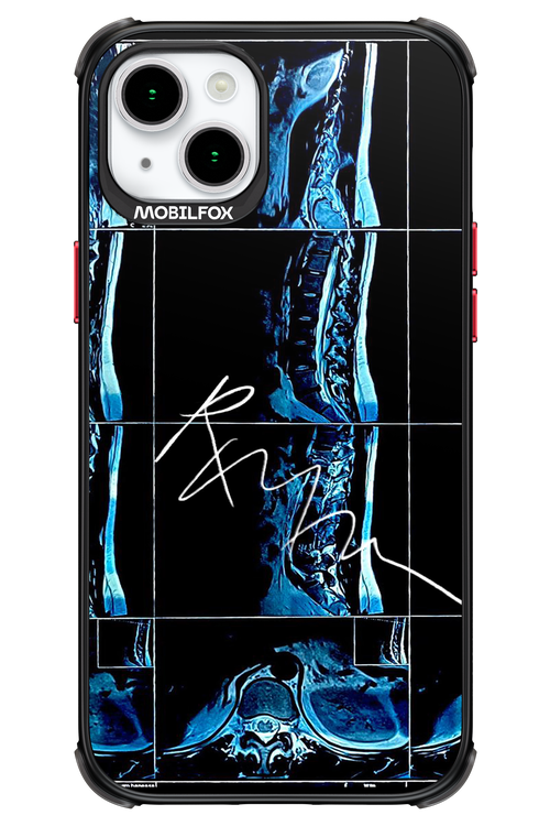 RMN Scolioza 2.0 - Apple iPhone 15 Plus