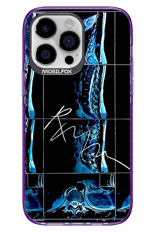 RMN Scolioza 2.0 - Apple iPhone 14 Pro Max