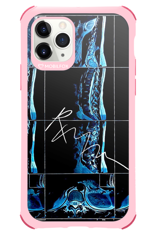 RMN Scolioza 2.0 - Apple iPhone 11 Pro