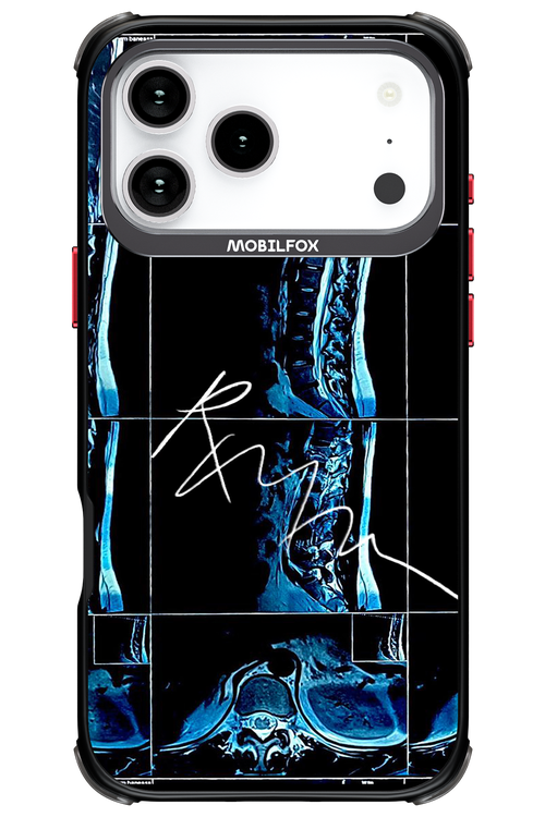 RMN Scolioza 2.0 - Apple iPhone 17 Pro Max
