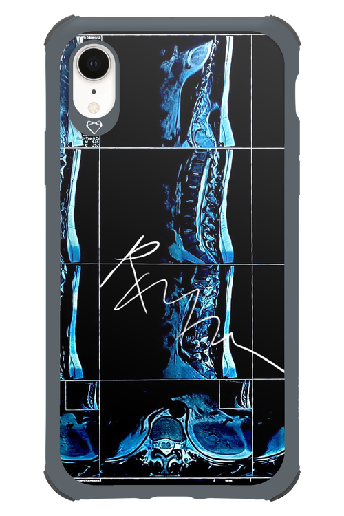 RMN Scolioza 2.0 - Apple iPhone XR