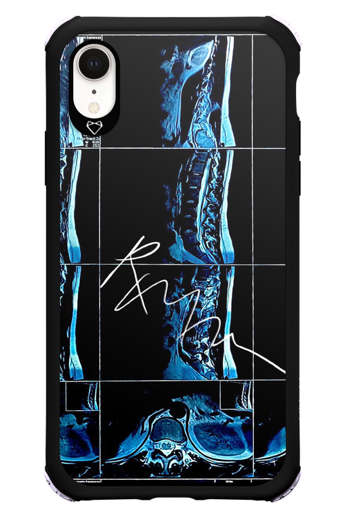 RMN Scolioza 2.0 - Apple iPhone XR