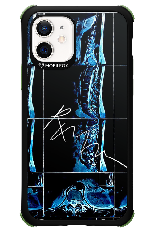 RMN Scolioza 2.0 - Apple iPhone 12