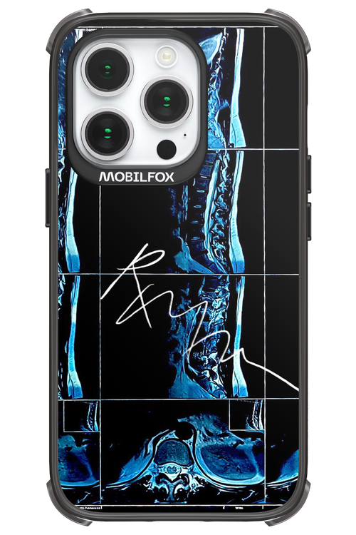 RMN Scolioza 2.0 - Apple iPhone 14 Pro