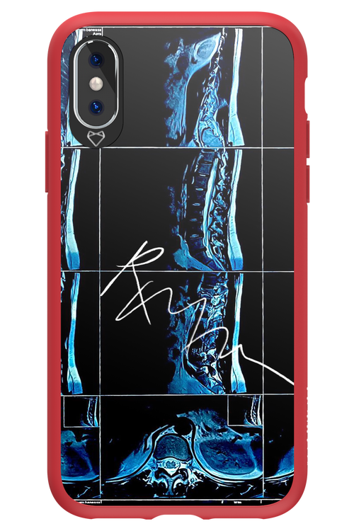 RMN Scolioza 2.0 - Apple iPhone X