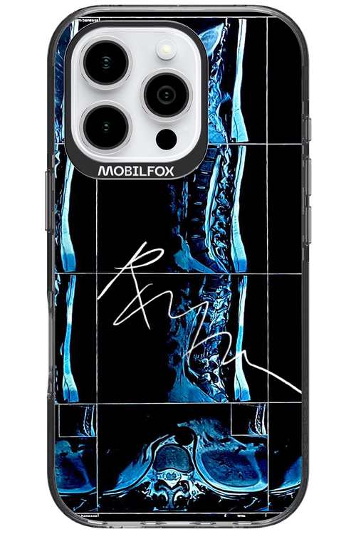 RMN Scolioza 2.0 - Apple iPhone 16 Pro