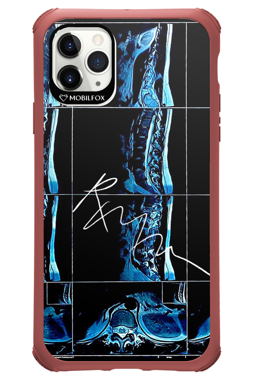 RMN Scolioza 2.0 - Apple iPhone 11 Pro Max