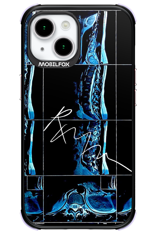 RMN Scolioza 2.0 - Apple iPhone 15