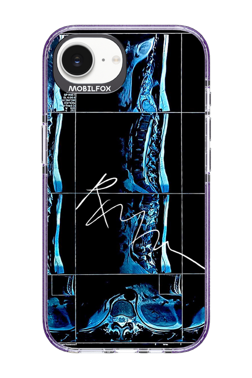 RMN Scolioza 2.0 - Apple iPhone 16e