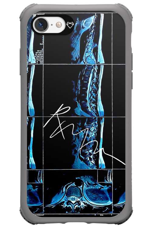 RMN Scolioza 2.0 - Apple iPhone 7