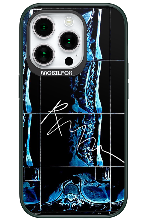 RMN Scolioza 2.0 - Apple iPhone 15 Pro
