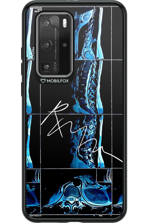 RMN Scolioza 2.0 - Huawei P40 Pro