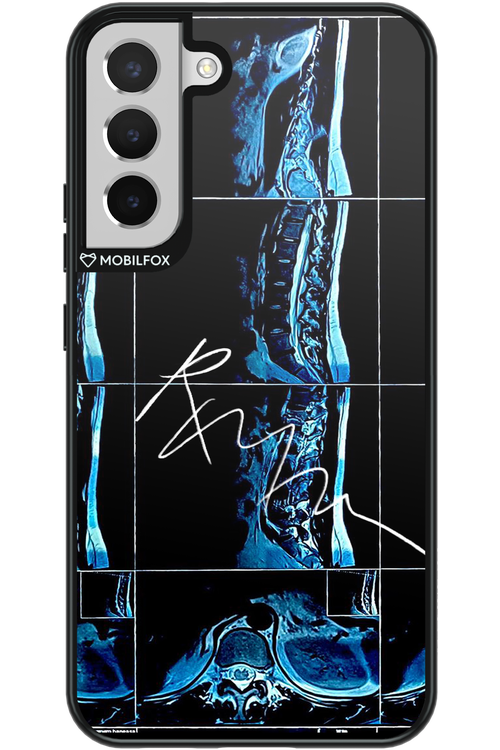 RMN Scolioza 2.0 - Samsung Galaxy S22+
