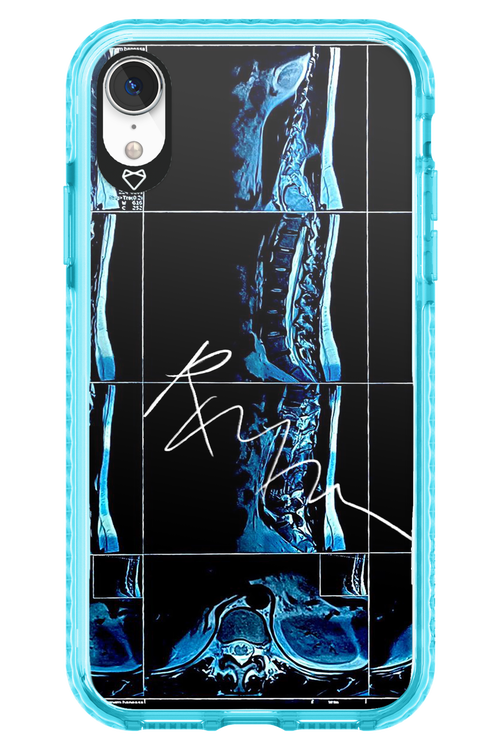 RMN Scolioza 2.0 - Apple iPhone XR