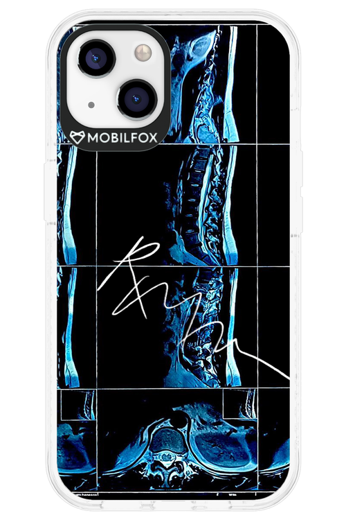 RMN Scolioza 2.0 - Apple iPhone 13