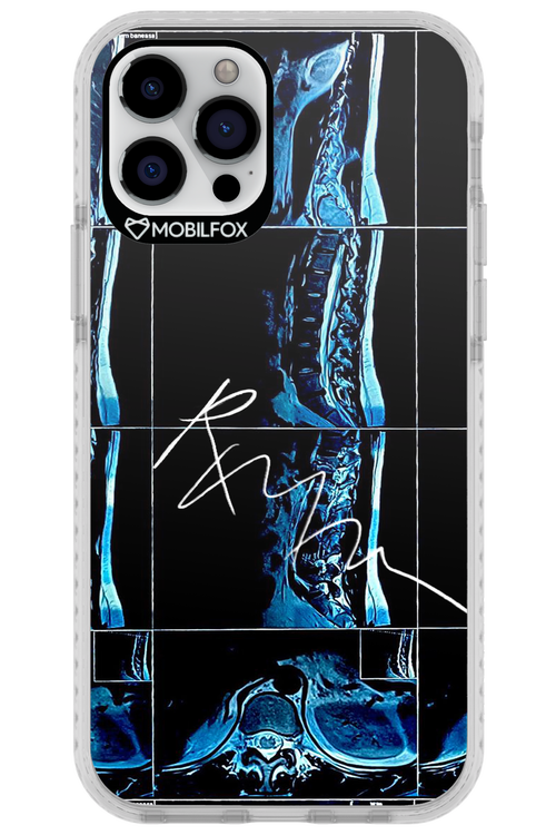 RMN Scolioza 2.0 - Apple iPhone 12 Pro