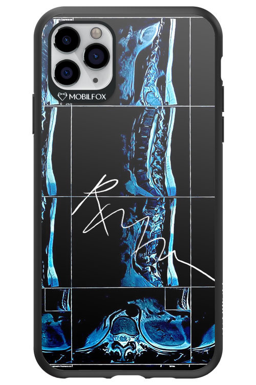 RMN Scolioza 2.0 - Apple iPhone 11 Pro Max