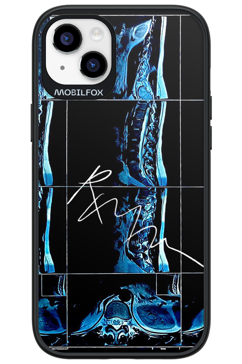 RMN Scolioza 2.0 - Apple iPhone 14 Plus