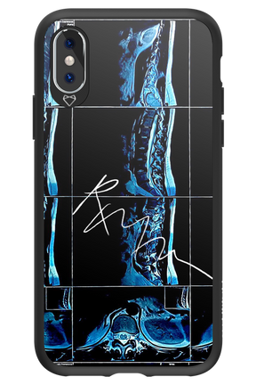 RMN Scolioza 2.0 - Apple iPhone X