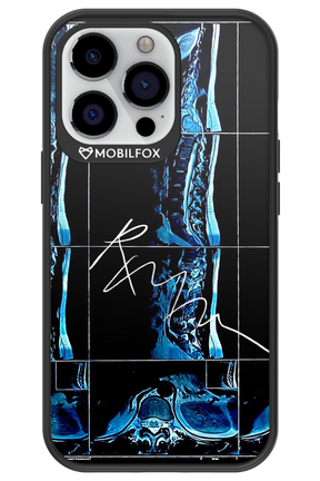 RMN Scolioza 2.0 - Apple iPhone 13 Pro
