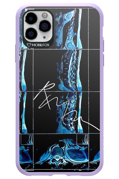 RMN Scolioza 2.0 - Apple iPhone 11 Pro Max