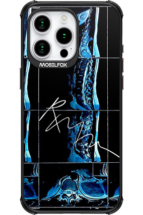 RMN Scolioza - Apple iPhone 15 Pro Max