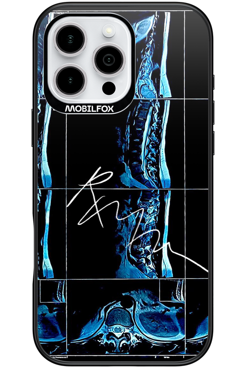RMN Scolioza 2.0 - Apple iPhone 16 Pro Max