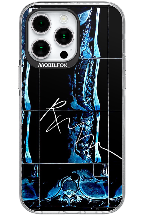 RMN Scolioza 2.0 - Apple iPhone 15 Pro Max