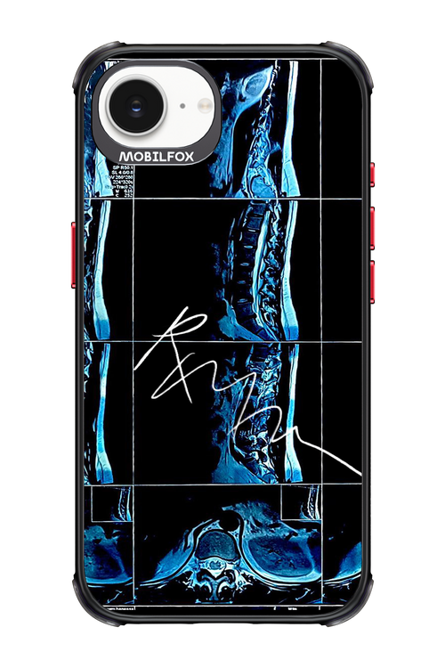 RMN Scolioza 2.0 - Apple iPhone 17e