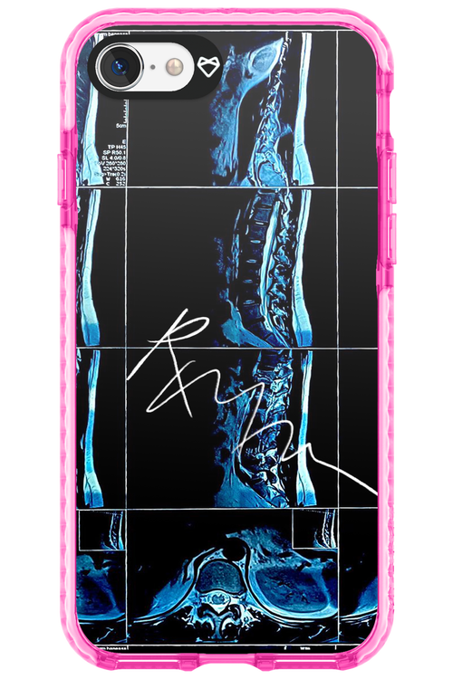 RMN Scolioza 2.0 - Apple iPhone 7
