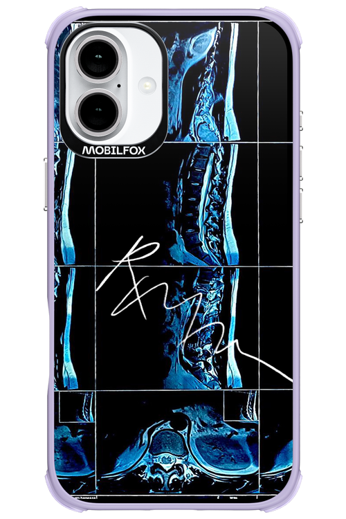 RMN Scolioza 2.0 - Apple iPhone 16 Plus