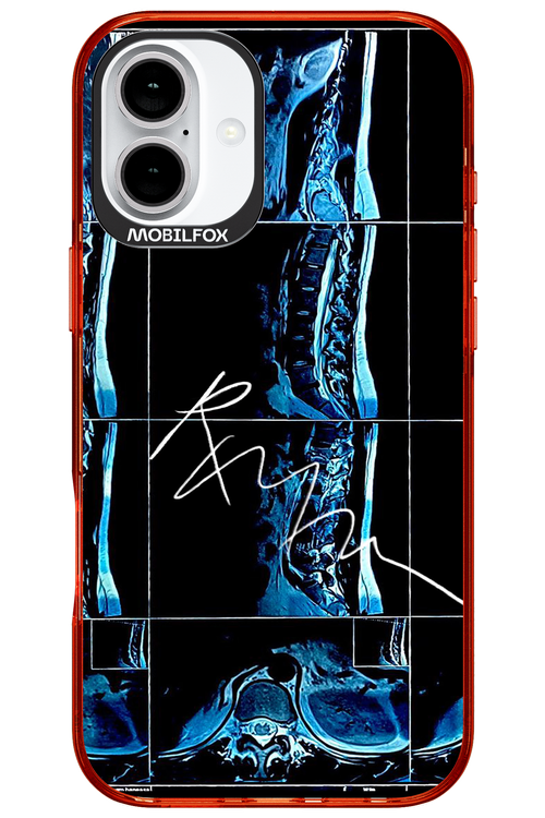 RMN Scolioza 2.0 - Apple iPhone 16 Plus