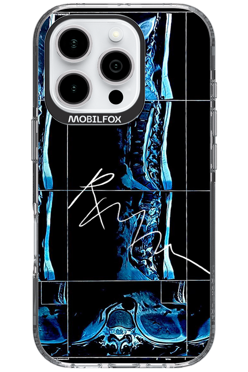 RMN Scolioza 2.0 - Apple iPhone 16 Pro