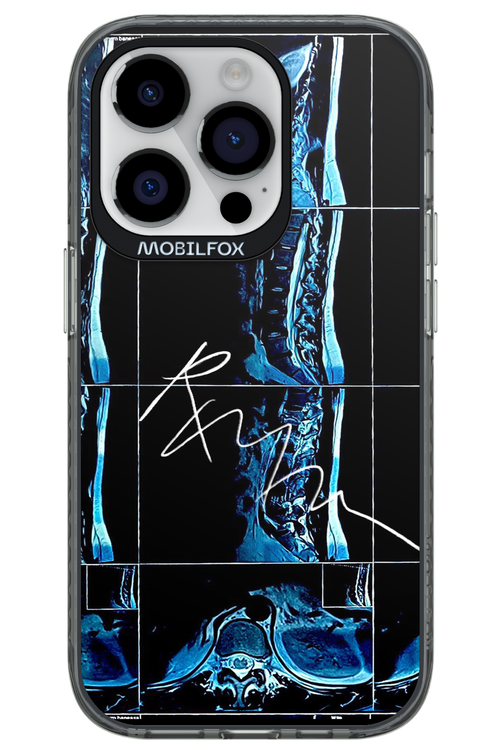 RMN Scolioza 2.0 - Apple iPhone 14 Pro