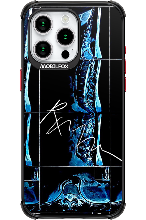 RMN Scolioza 2.0 - Apple iPhone 15 Pro Max