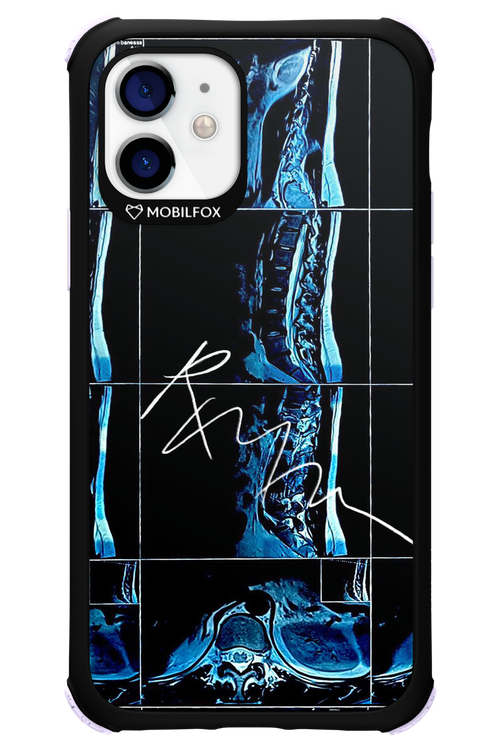 RMN Scolioza 2.0 - Apple iPhone 12