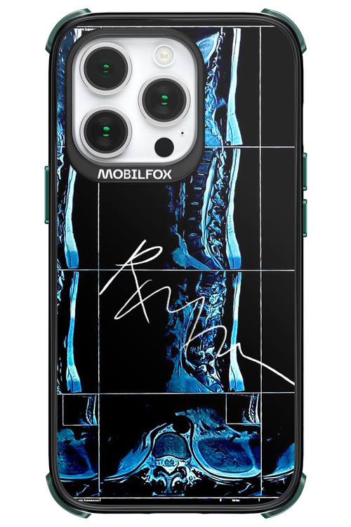 RMN Scolioza 2.0 - Apple iPhone 14 Pro