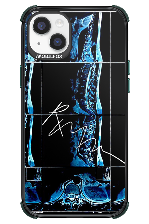 RMN Scolioza 2.0 - Apple iPhone 14 Plus
