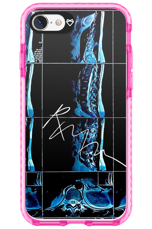 RMN Scolioza 2.0 - Apple iPhone 8