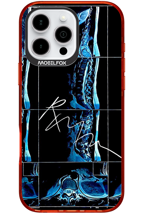 RMN Scolioza 2.0 - Apple iPhone 16 Pro Max