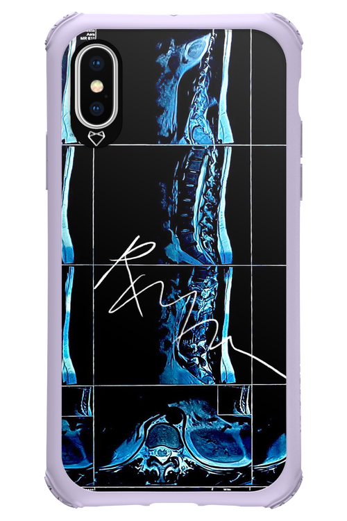 RMN Scolioza 2.0 - Apple iPhone XS