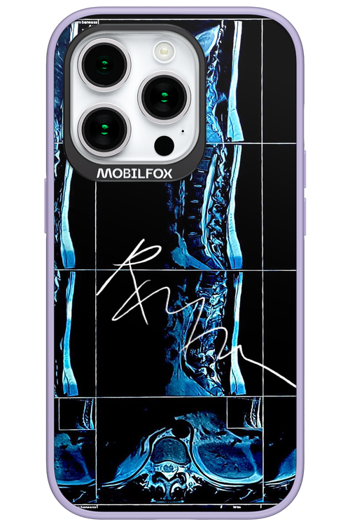 RMN Scolioza 2.0 - Apple iPhone 15 Pro