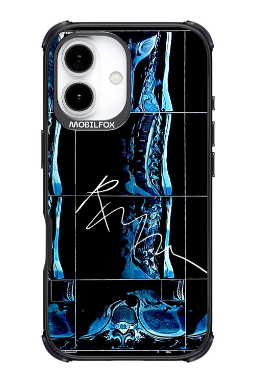 RMN Scolioza 2.0 - Apple iPhone 17