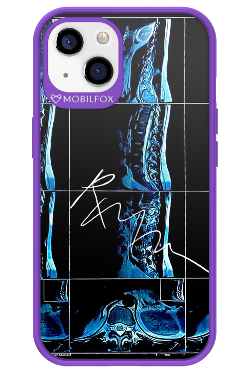 RMN Scolioza 2.0 - Apple iPhone 13