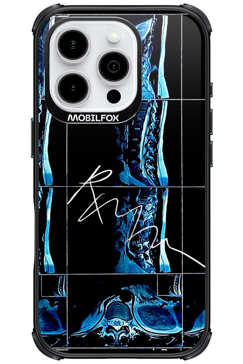 RMN Scolioza 2.0 - Apple iPhone 16 Pro