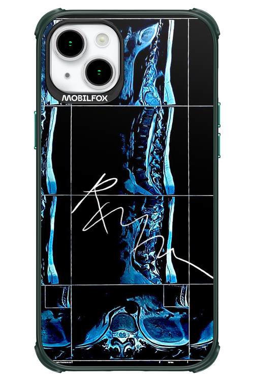 RMN Scolioza 2.0 - Apple iPhone 15 Plus